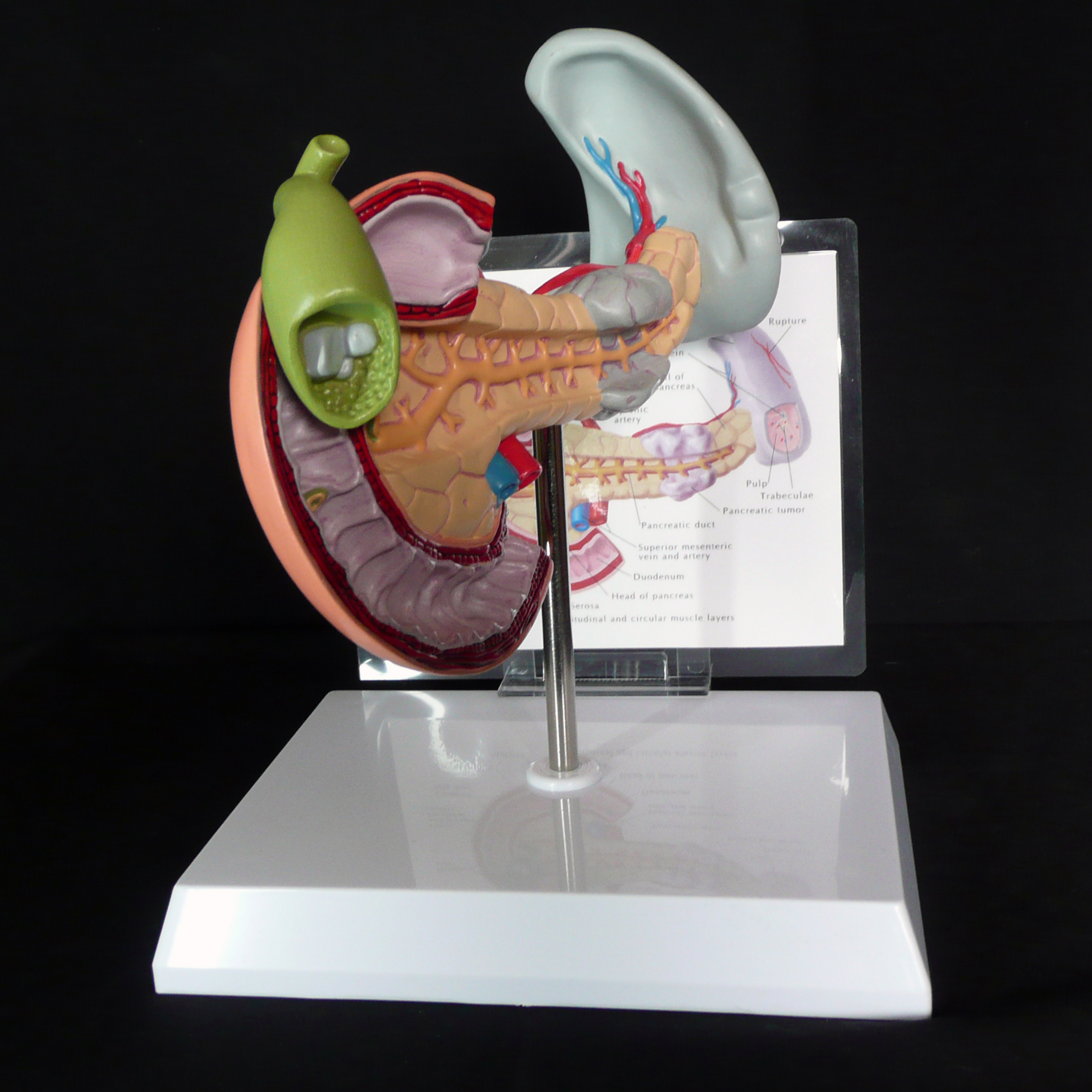 Anatomical Human Pancreas, Spleen and Gallbladder Pathological Diseases ...